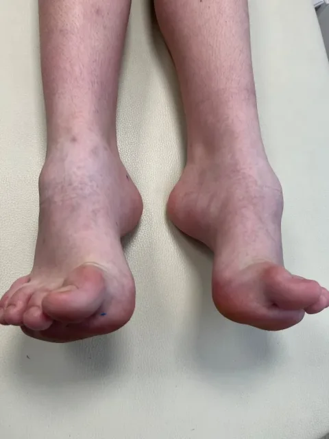 Atypická noha