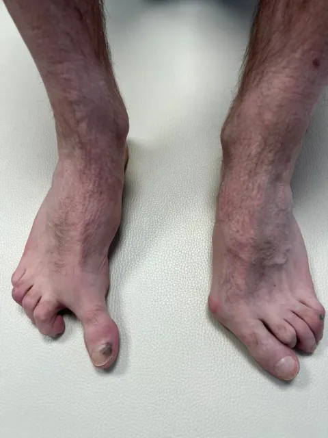 Deformity nohy