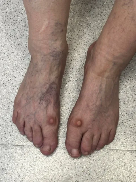 Vbočený palec (bunion)